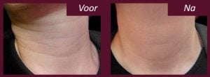 halslijnen botox voor en na