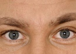 Foto van na de behandeling met botox van fronsrimpel man close-up