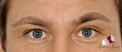 Foto van na de behandeling met botox van fronsrimpel man close-up