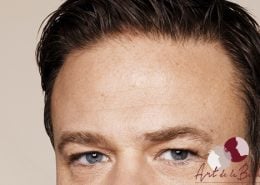 Na - behandeling met botox van voorhoofdrimpels man close up