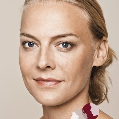 Na - behandeling met fillers van de wangen, wallen (ogen), lipcontour, voorhoofd en afhangende mondhoeken