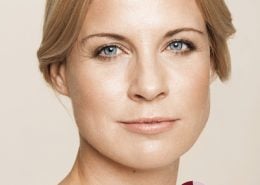 Na - behandeling met fillers van wallen (ogen), voorhoofd, afhangende mondhoeken en lipcontour