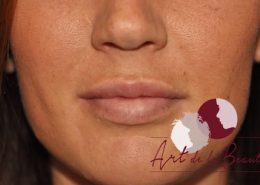 Foto van na de behandeling met fillers voor meer volume van de lippen (close up)