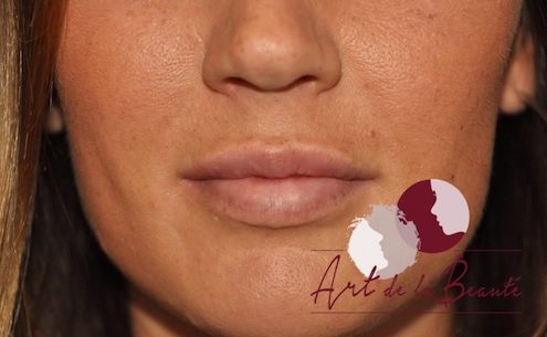 Foto van na de behandeling met fillers voor meer volume van de lippen (close up)