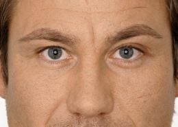 Foto van voor de behandeling met botox van fronsrimpel man