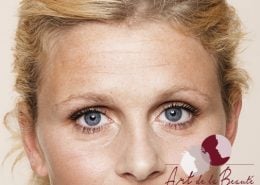 Foto van voor de behandeling met botox van voorhoofdrimpels vrouw close-up