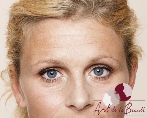 Foto van voor de behandeling met botox van voorhoofdrimpels vrouw close-up
