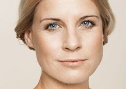 Voor - behandeling met fillers van wallen (ogen), voorhoofd, afhangende mondhoeken en lipcontour