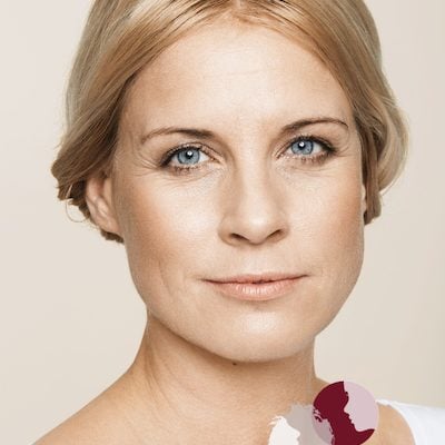 Voor - behandeling met fillers van wallen (ogen), voorhoofd, afhangende mondhoeken en lipcontour