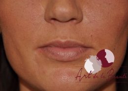 Foto van voor de behandeling met fillers voor meer volume van de lippen (close up)
