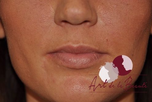 Foto van voor de behandeling met fillers voor meer volume van de lippen (close up)