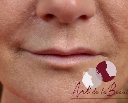 Foto van voor de behandeling met fillers voor meer volume van de lippen en correctie van de vorm close up