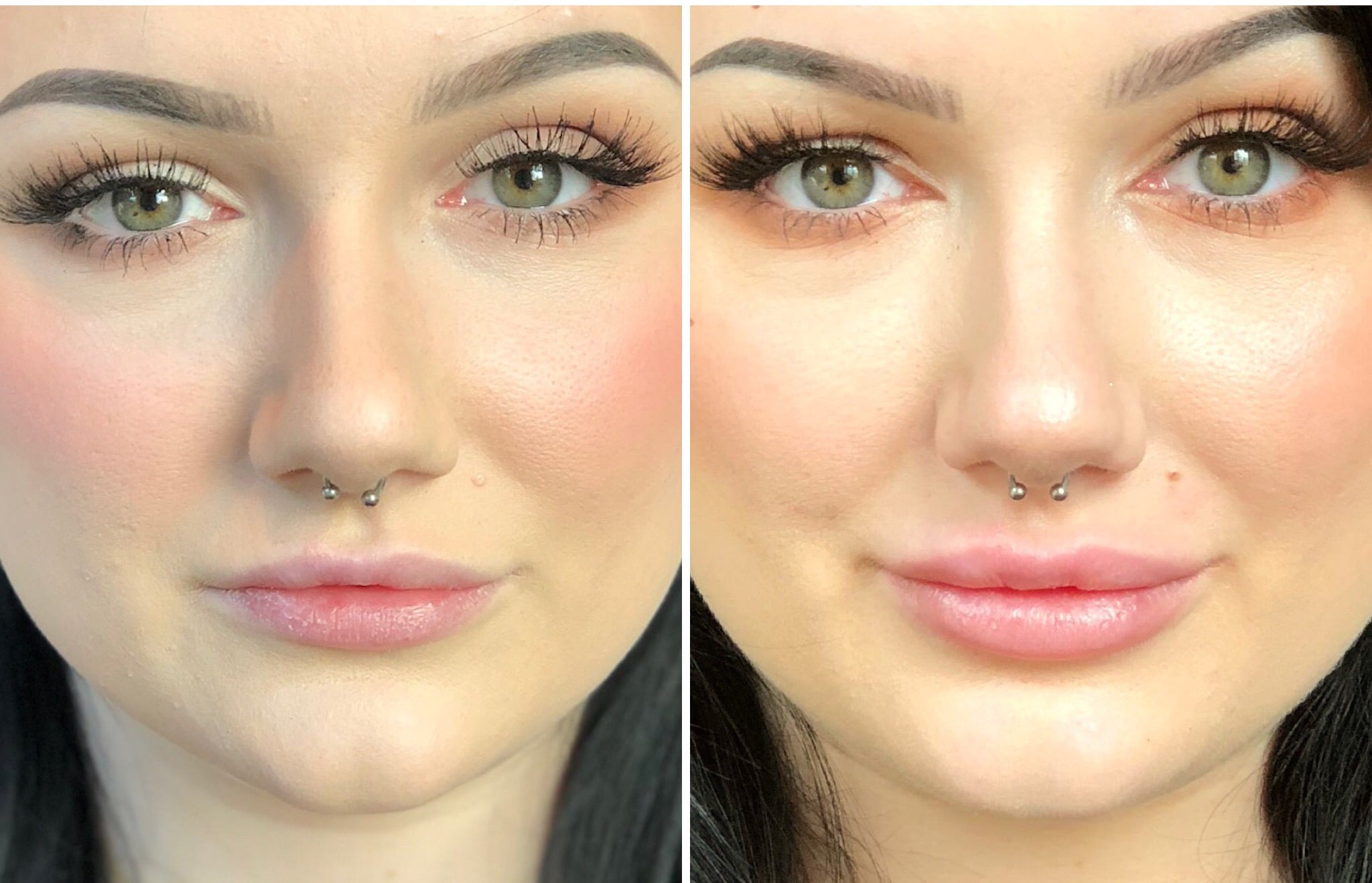 stylage lip fillers voor en na art de la beaute Art de la Beaute
