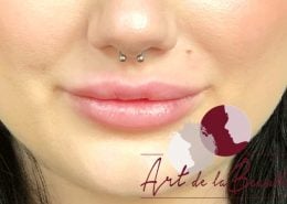 Volume behandeling lippen met fillers Stylage close - na