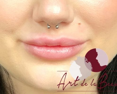 Volume behandeling lippen met fillers Stylage close - na