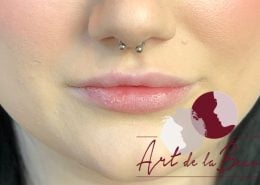 Volume behandeling lippen met fillers Stylage close - voor