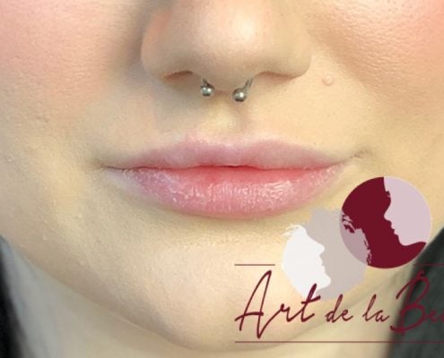 Volume behandeling lippen met fillers Stylage close - voor