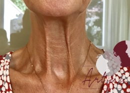 Halslijnen en nekrimpels botox behandeling - na