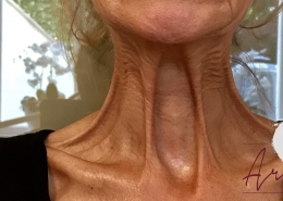 Halslijnen en nekrimpels botox behandeling - voor