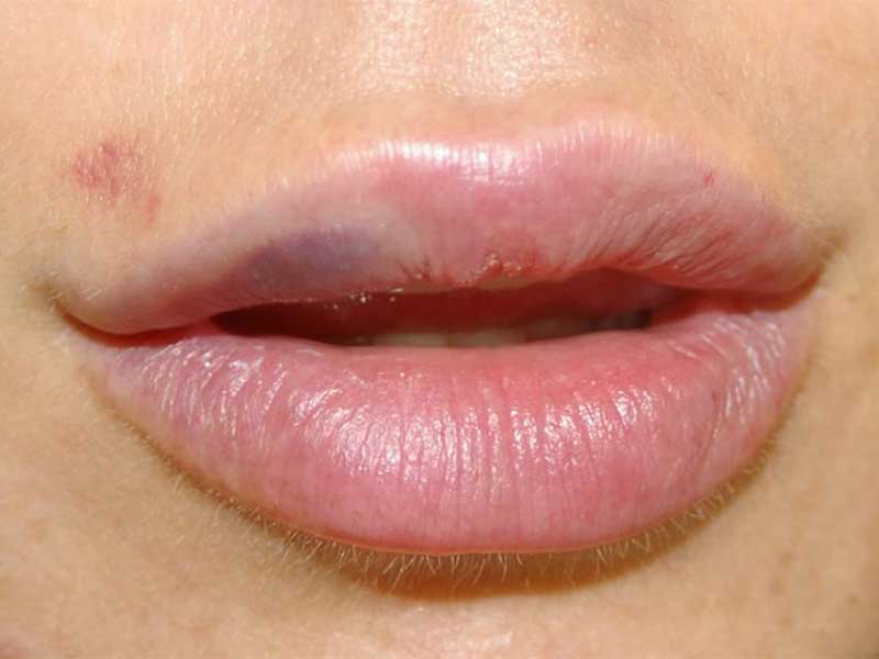 Lip Filler Na 2 Weken Weg Wat Te Verwachten En Hoe Te Handelen