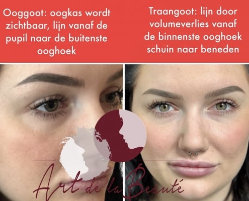 Verschil tussen ooggoot en traangoot