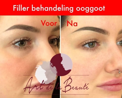 Filler behandeling ooggoot