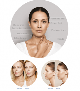 restylane skinbooster areas