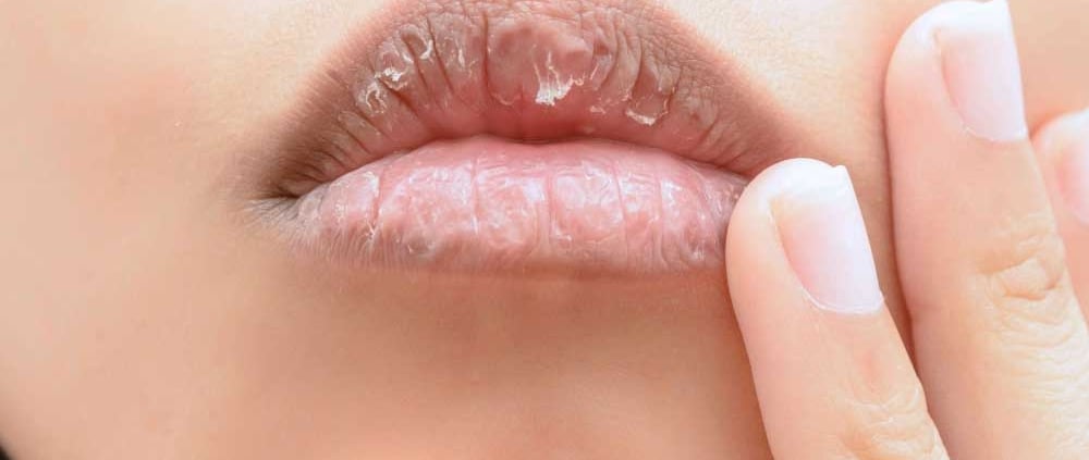 Zwelling bij lip fillers