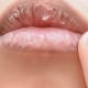 Zwelling bij lip fillers