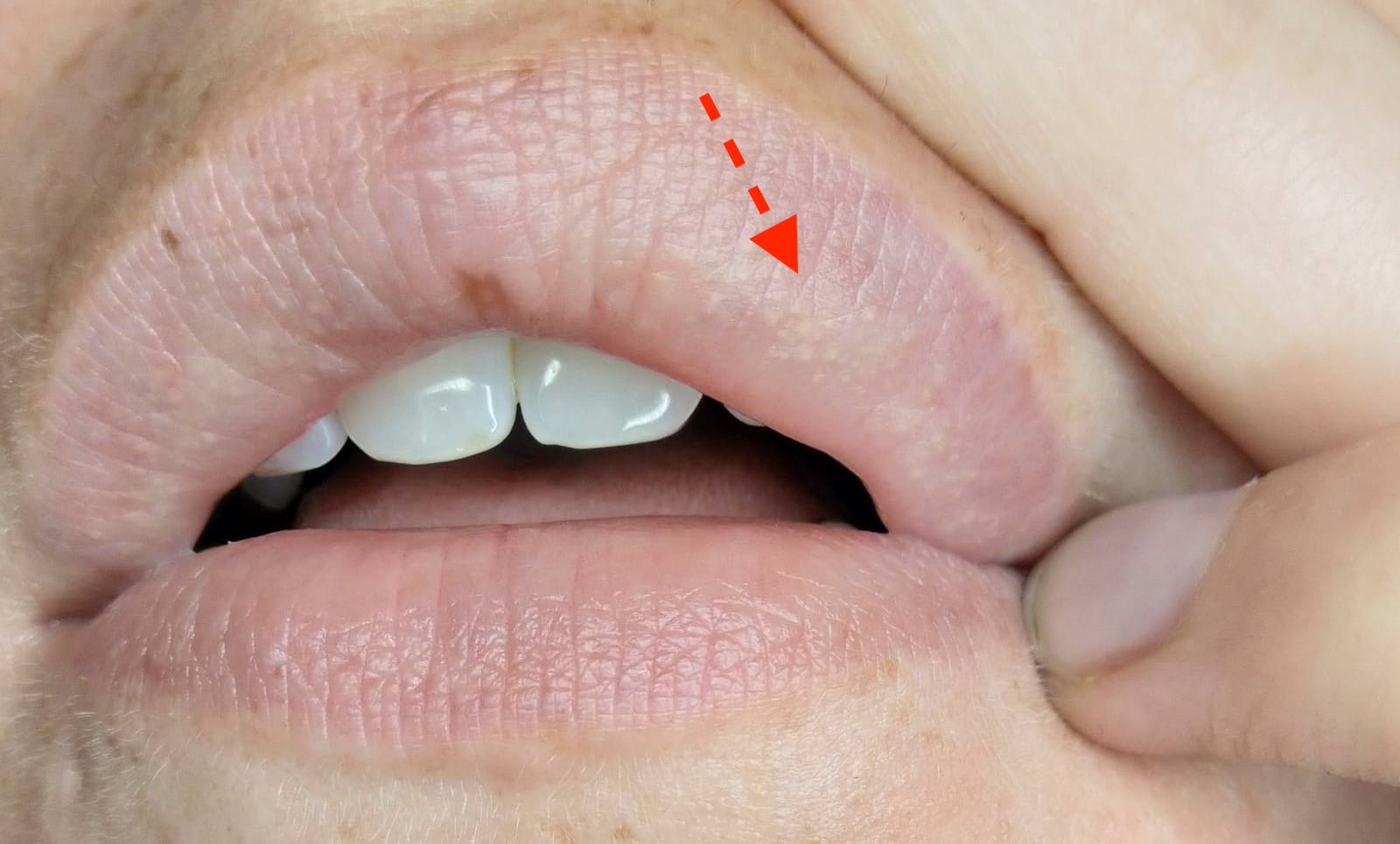 Witte stipjes / bultjes op de lippen wat zijn het? √ Art de la Beaute