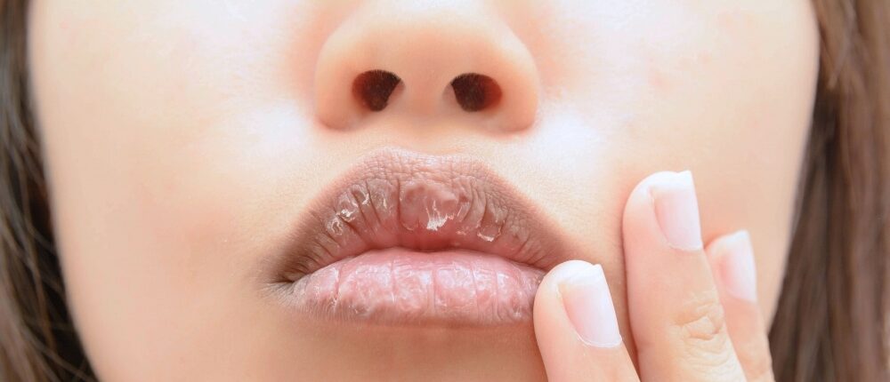 pijnlijke lippen na filler behandeling